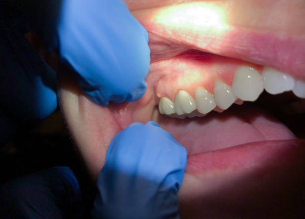 Best Emergency Dental Care for Broken or Chipped Teeth in Raintree Plantation, MO
